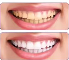Tiras Blanqueadoras Dentales Purple Shine — Efecto Inmediato con Extractos Vegetales | Sin Sensibilidad
